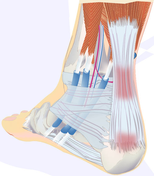 achilles tendonitis after ankle sprain