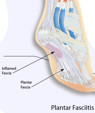 plantar fasciitis cause ankle pain